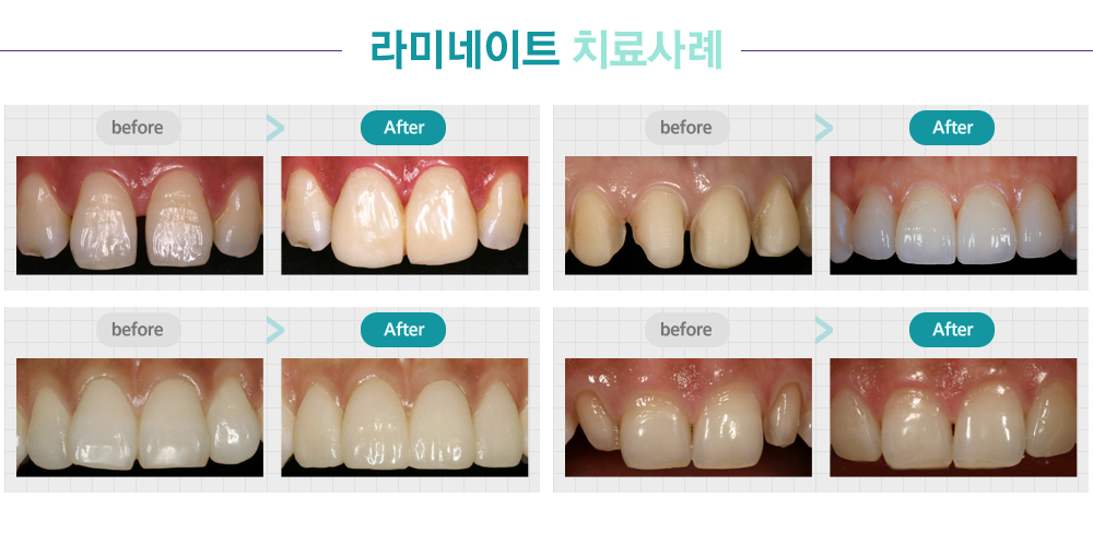 라미네이트 치료사례